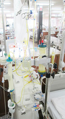 腹水濃縮再静注法