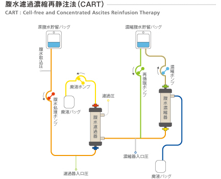 腹水濃縮再静注法