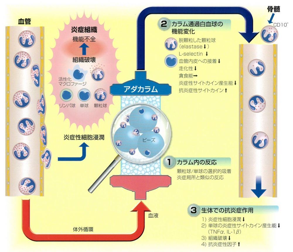 顆粒球除去療法